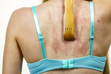Woman scratching her itchy back using scratcher