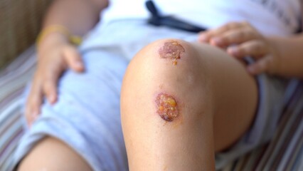Knee wounds with inflammation and redness of the skin - treat and disinfect the wound with...