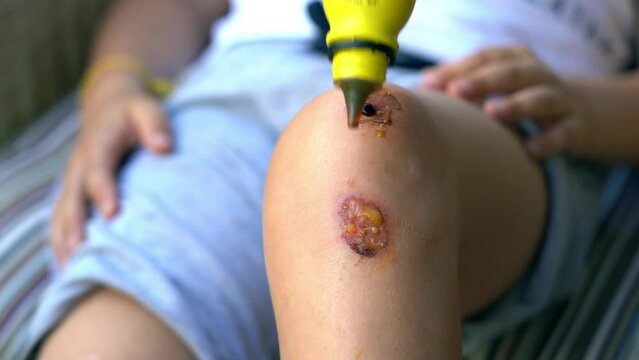 Knee wounds with inflammation and redness of the skin - treat and disinfect the wound with disinfectant and gauze prior to scab formation