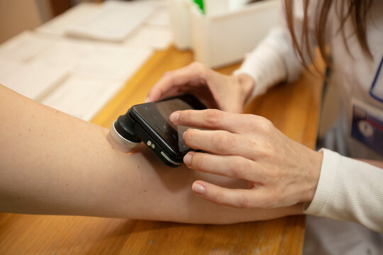 Doctor dermatologist examining birthmarks and moles on a female patient's hand. Close up cropped image of examination of birthmarks with modern device, using light and phone application and camera