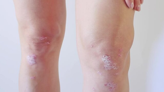 Knee joint effusion , water on the knee.Acute psoriatic arthritis, arthrosis ,meniscus injury.Excess synovial fluid in and around the left knee joint