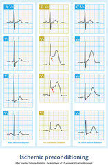 Ischemic preconditioning is a kind of myocardial ischemic protection. After multiple transient myocardial ischemia, it can reduce the degree of myocardial injury caused by severe ischemia in the later