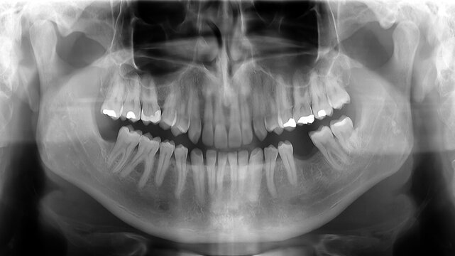 Panoramic x-ray radiograph showing teeth in a human jaw