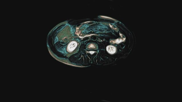 Bulk multicolored CT scan of the abdomen. Computed tomography of the gastrointestinal tract, liver and kidneys