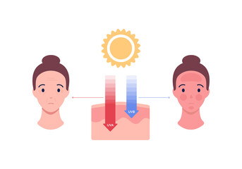 Uv rays and visible light healthcare infographic. Vector flat people illustration. UVA, UVB arrow penetrate skin layers. Sunburn and aging female avatar. Design for uv awareness month. - obrazy, fototapety, plakaty