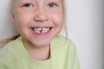 Portrait of a little girl with a wide smile without a milk front tooth. Loss of a baby tooth,...