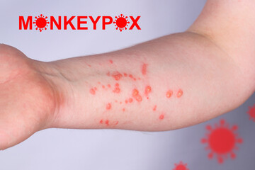 Hand of a young guy in a rash. Monkeypox virus symptoms