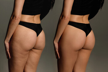 Buttocks and hips woman with cellulite and stretch marks close-up before and after liposuction procedure and cosmetic therapy - obrazy, fototapety, plakaty