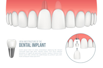 Realistic upper jaw with healthy tooth and dental implant. Scheme with installation of dental implant with all parts: crown, abutment, screw. Vector illustration with place for your text © Vitalex