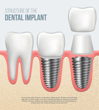Realistic dental implant structure with all parts: crown, abutment, screw. Vector illustration