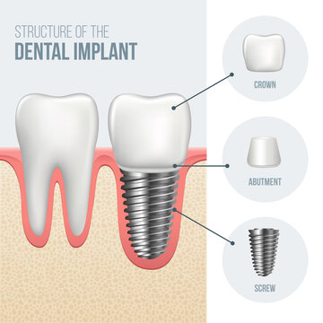 Realistic healthy tooth and structure, dental implant structure with all parts: crown, abutment, screw. Vector illustration
