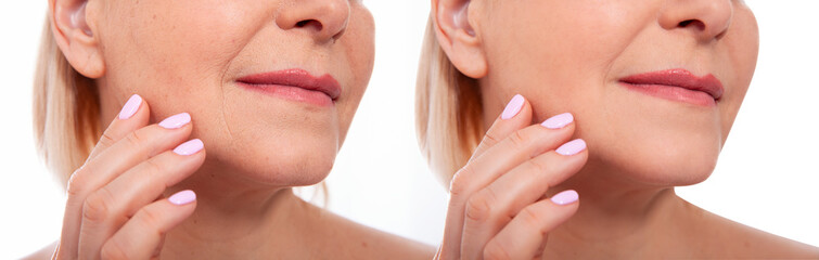 Middle age close up woman face before after cosmetic procedures. Skin care for wrinkled face....
