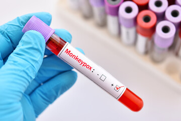 Fototapeta premium Blood sample tube positive with Monkeypox virus, new epidemic disease in 2022