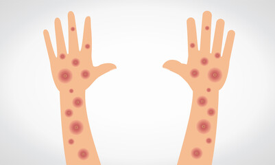 Monkeypox virus. Vectorial monkeypox virus on hand and arm. 