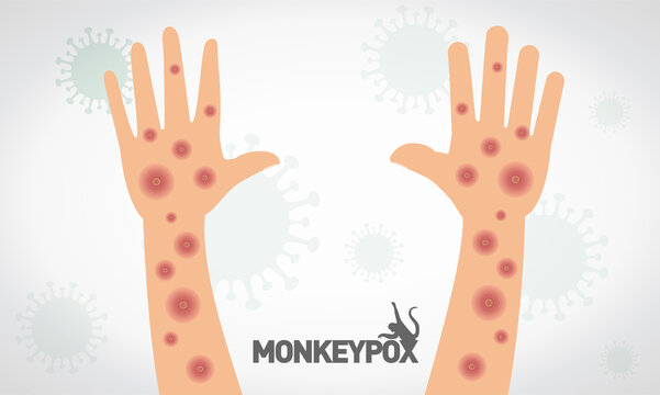 Monkeypox virus. Vectorial monkeypox virus on hand and arm. Virus symbol on background.