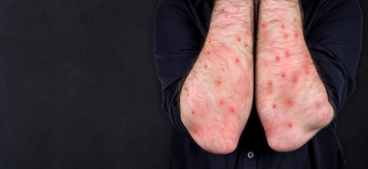 MONKEYPOX. The man's hands are blistered from monkeypox. Virus, epidemic, disease. Black background. - obrazy, fototapety, plakaty