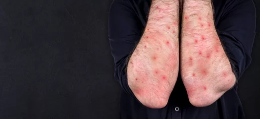 Gardinen MONKEYPOX. The man's hands are blistered from monkeypox. Virus, epidemic, disease. Black background. © Hit Stop Media