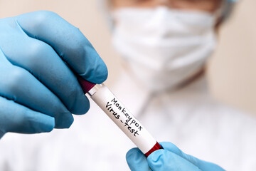 A medical worker holds a test tube with Monkeypox virus infected blood sample in his hands,hands in...