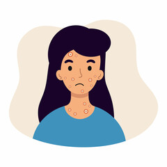 Girl with ulcers on her face. Symptoms of monkeypox. Monkey pox. Skin rash.