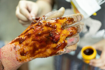 Applying medicine to treat burns on the hands. treating burns on male's hand.
