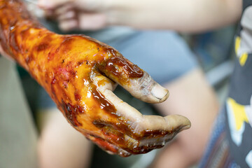 Applying medicine to treat burns on the hands. treating burns on male's hand.