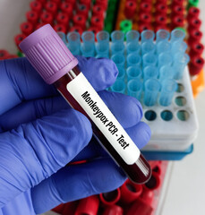 Blood sample tube for Monkeypox virus PCR test. It is a double-stranded DNA, zoonotic virus and a species of the genus Orthopoxvirus in the family Poxviridae.