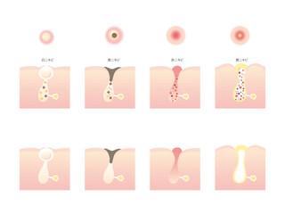 色々なニキビのイラスト