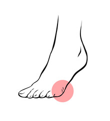 Line sketch female leg with problematic pain. Orthopedic disease plantar fasciitis. Beauty and health of feet. Vector isolated outline illustration
