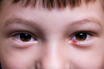 close up of a child face,  with an inflamed upper eyelid.