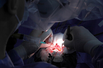 Treatment of a brain aneurysm. Surgical operation on the brain. A team of surgeons performing brain surgery to remove a tumor.
