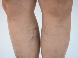 Varicose veins on the leg woman. closeup photo, blurred.