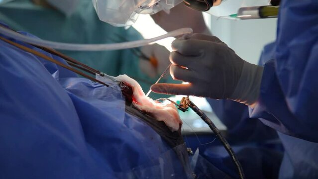 Treatment of a brain aneurysm. Surgical operation on the brain. A team of surgeons performing brain surgery to remove a tumor.