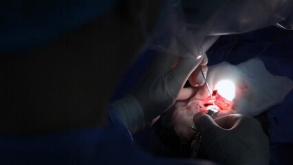 Treatment of a brain aneurysm. Surgical operation on the brain. A team of surgeons performing brain surgery to remove a tumor.