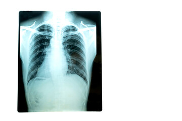 X-ray film of the lungs of a male patient in the hospital  on a white background.