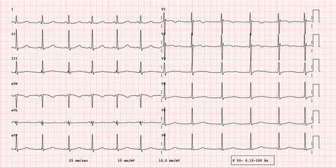 ECG example of a pathological 12-lead rhythm. Long QT syndrome, real exam