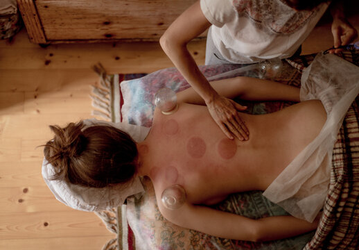 High angle view of relaxed young woman receiving cupping treatment on back, traditional chinese medicine.