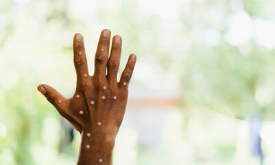 Monkeypox infection pandemic.African hand symptom monkeypox show doctor in laboratory lab...