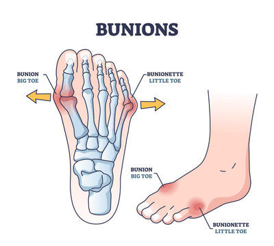 Bunions and bunionette as feet bone disorder condition outline diagram. Labeled educational medical state with hallux valgus deformation disease vector illustration. Big toe and foot connected joint.
