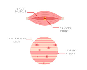 Illustration of a trigger-point complex at a longitudinal section of muscle. Cause of muscle pain. Illustration for anatomy study, medicine or health topics.