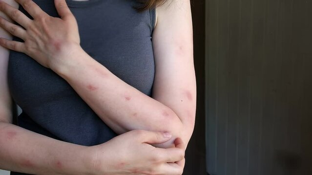 Woman scratches her hands with rash, red spots blisters. Monkeypox new disease dangerous over the world. Patient with Monkey Pox. Close up rash, human with Health problem. Copy space
