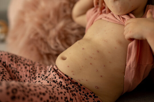 Little toddler girl with chicken pox in bed, playing at home, quarantine isolation