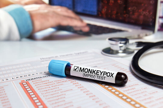 Doctor's work table with a blood tube diagnosed infection with Monkeypox (MPXV) disease. medical office work table with a blood sample from a patient positive for monkey pox virus (MPXV)