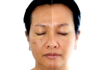 Retouched image to show before and after treatment spot melasma pigmentation facial treatment on young asian woman face. Skincare and health problem concept.