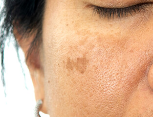 Close up woman's skin texture with black spot melasma pigmentation on asian woman face. Skincare...