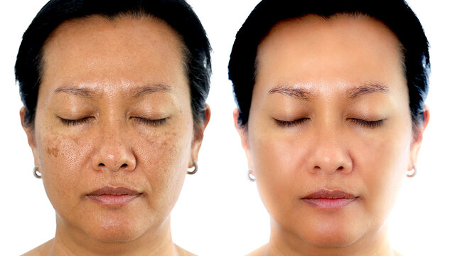 etouched image to show before and after treatment spot melasma pigmentation facial treatment on young asian woman face. Skincare and health problem concept.