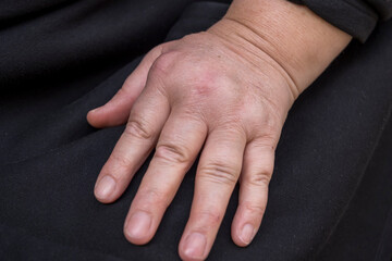 Hand Of Woman Deformed From Rheumatoid Arthritis. a chronic progressive disease causing...