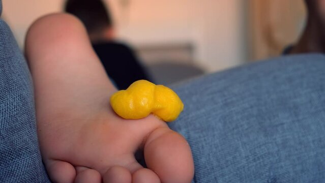 Applying foam remedy on boy's foot after wart laser-removed, close-up view. Treatment with a foam analgesic anti-inflammatory medicine. Sore, wound after operation. Wound of removed wart.