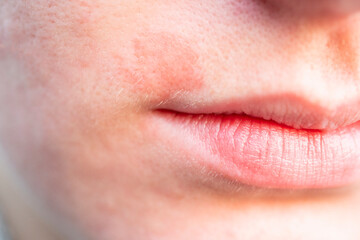 Skin irritation on woman face close to the lips.