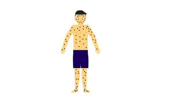 An animation of monkeypox crisis. A men cartoon been hit with pox during this disease and monkeypox word appear.