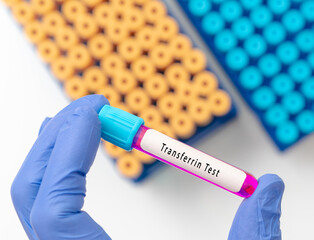Obraz premium Biochemistry Blood sample for Transferrin test
